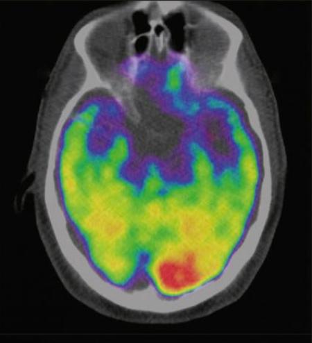 A scan of a brain used in a study which associates the brain region called the amygdala, an area linked to stress, to greater risk of heart disease and stroke is seen in an undated image released January 11, 2017 by The Lancet which published the research.