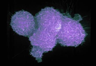 An electron micrograph of a prostatic cancer cell, mag. 3600x. is seen in this undated handout photo.