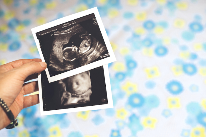 Woman holds ultrasound images