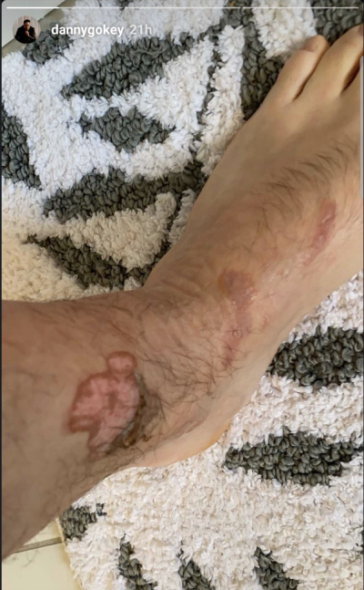 Danny Gokey post a photo of his legs which were burned while on tour, Nov 12, 2019