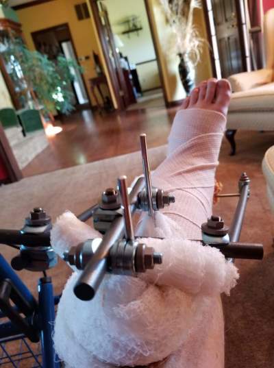 Michael Robertson lays back in a cast after breaking his foot and leg in a motorcycle accident in Zionsville, Indiana. 