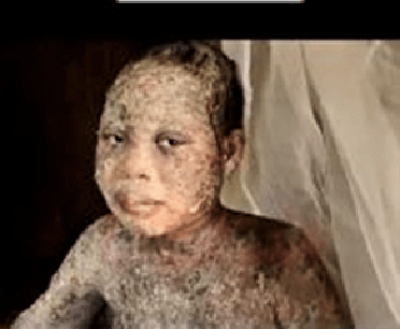 Amina Nagudi, 13, was sprayed with acid in Namutumba District, Uganda, on March 8, 2022.