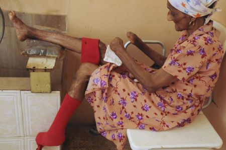 Leprosy victim at hospital on July 9, 2012.