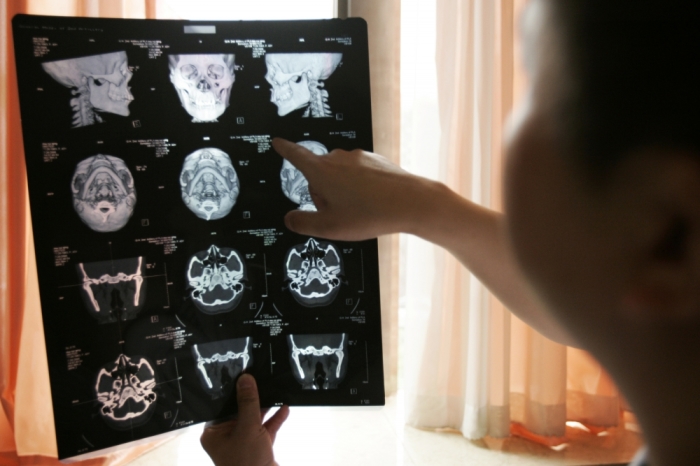 A surgeon shows an x-ray of a patient before a facial reconstruction operation in Beijing, China, July 27, 2006.