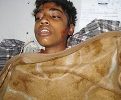 Two Muslims Burn 14-Year-Old Christian Boy in Pakistan; Victim in Hospital with 55% Burn