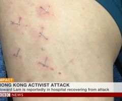 Christian Democracy Activist Tortured With Cross-Shaped Staples in Hong Kong