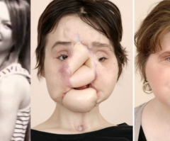 How Faith Helped America's Youngest Face Transplant Recipient Want to Live Again