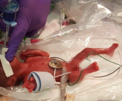 World’s smallest surviving baby born at 23 weeks celebrated by pro-life advocates