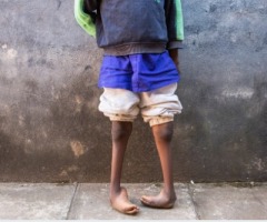 How we can kick Clubfoot for good