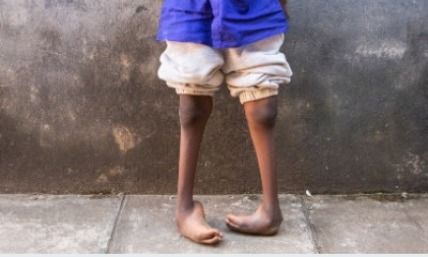 How we can kick Clubfoot for good