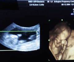 Pre-Born to 'Speak' Through Live Ultrasounds on Capitol Hill